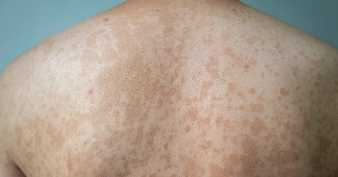 Tinea Versicolor—The Struggle & How I Manage It